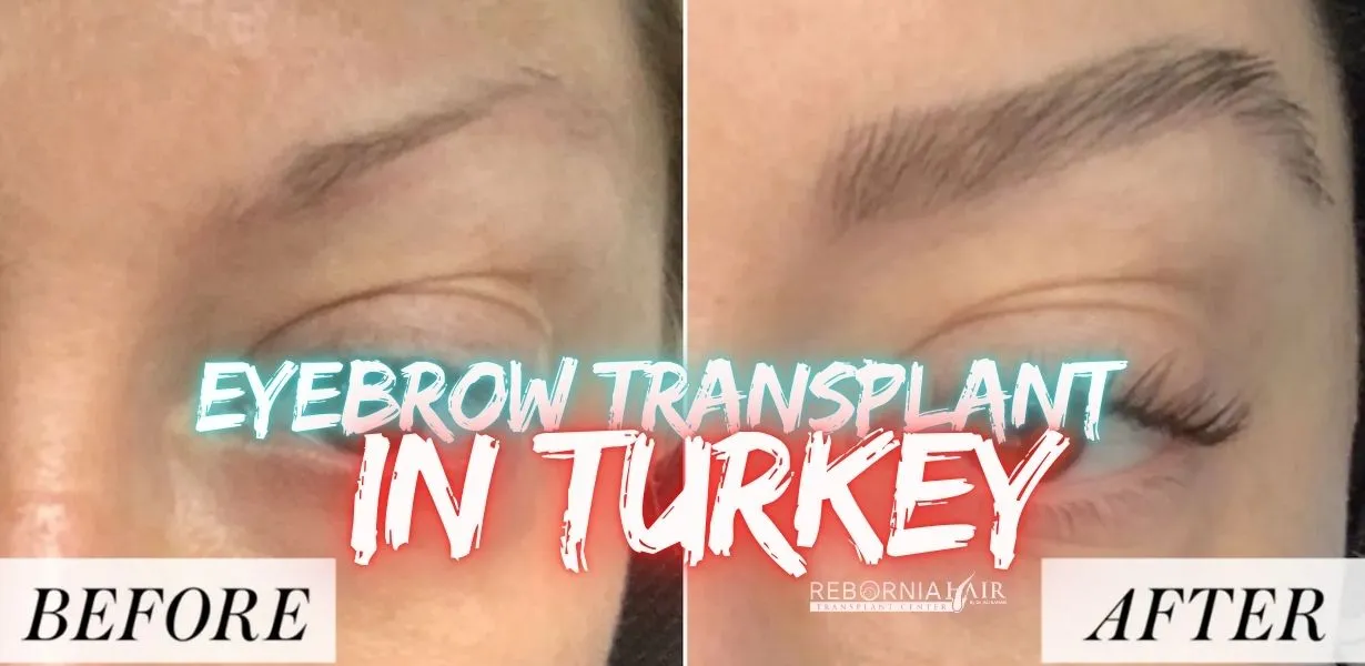 Eyebrow Transplant in Turkey: 2025 Guide