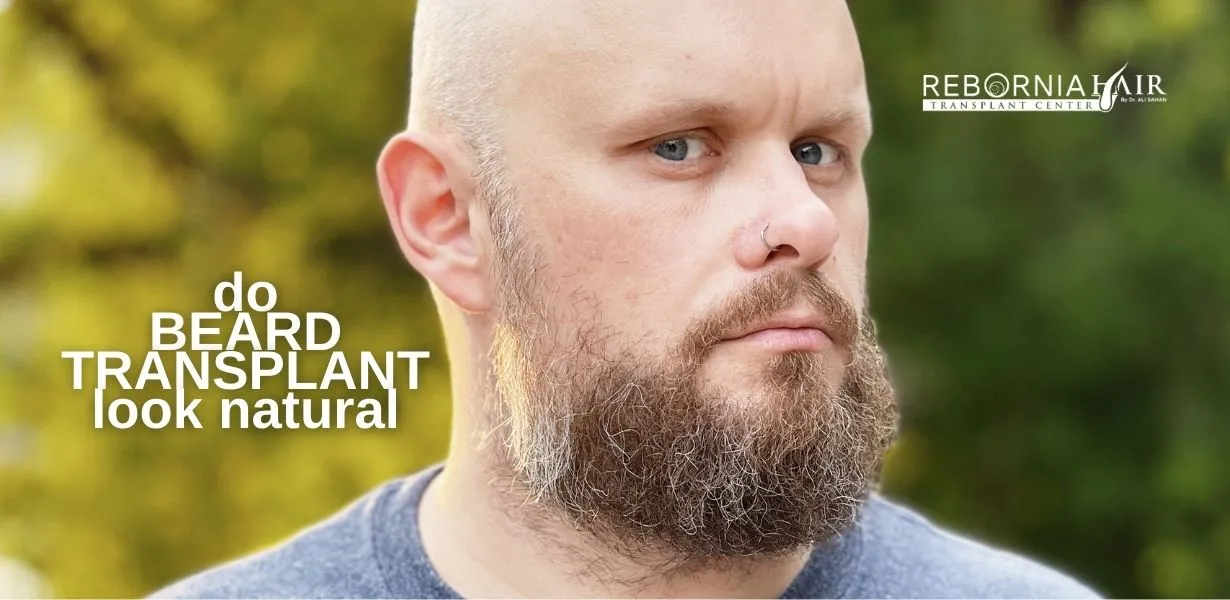Do Beard Transplants Look Natural?