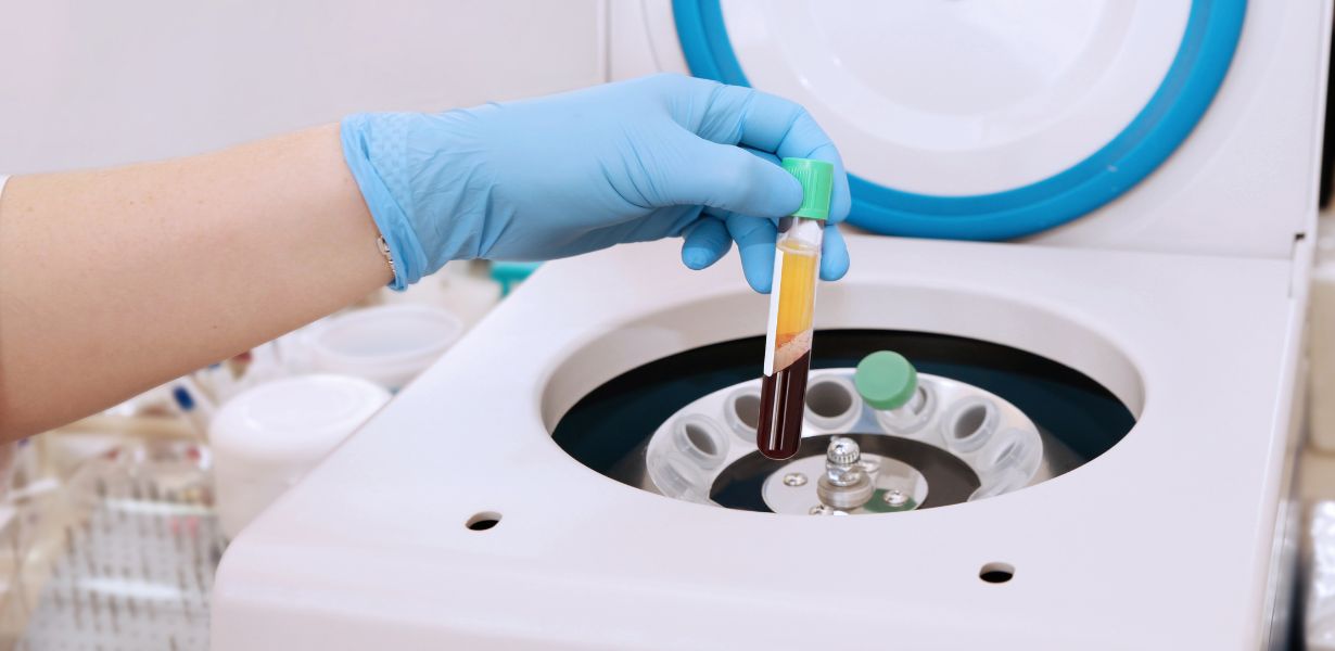 PRP For Hair Loss