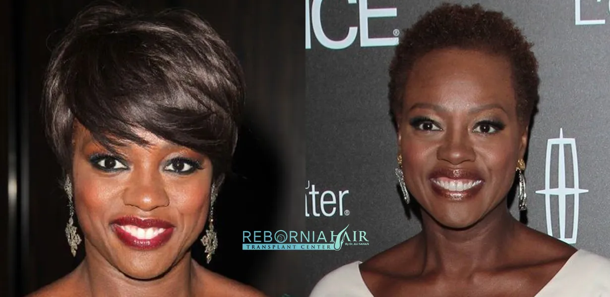 17 Female Celebrities With Hair Loss