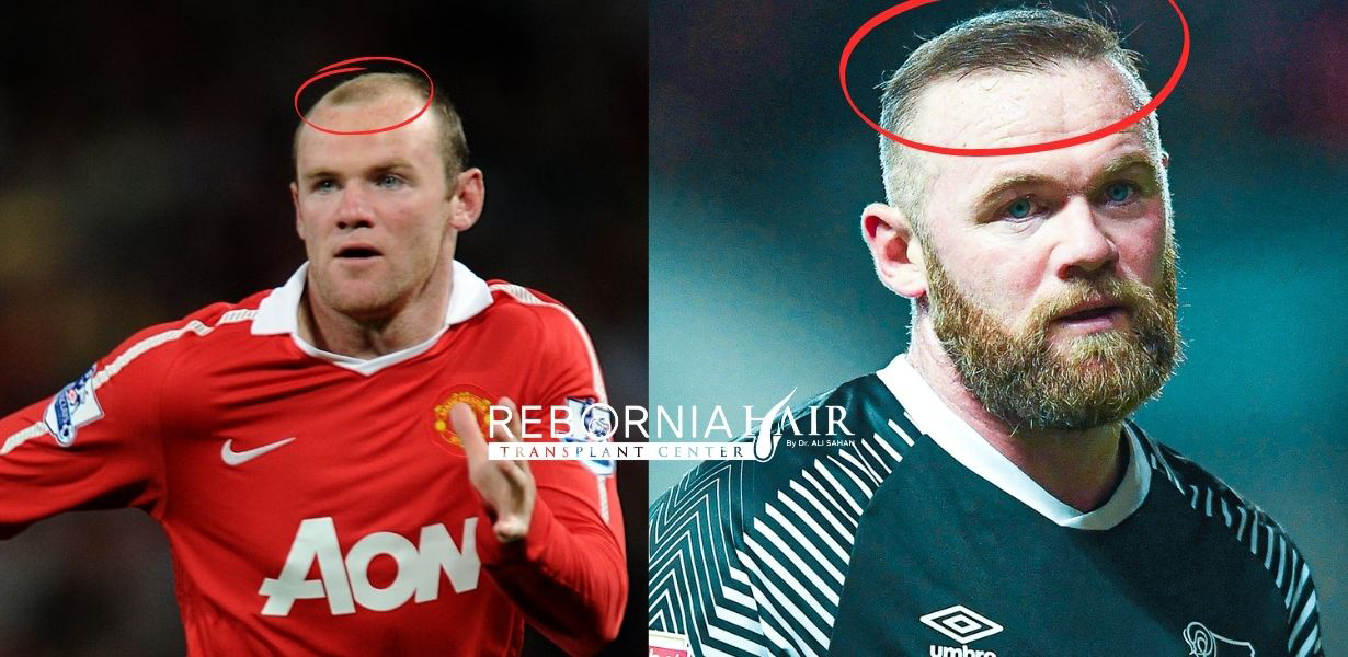 20 Celebrity Hair Transplants Before & After